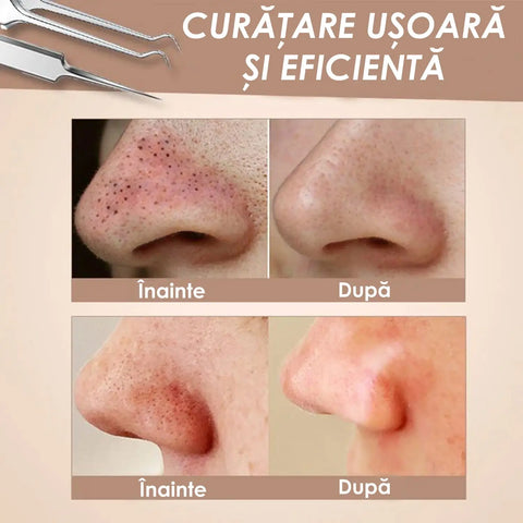 Set 8 Ustensile pentru Comedoane si Puncte Negre TWEEZ™