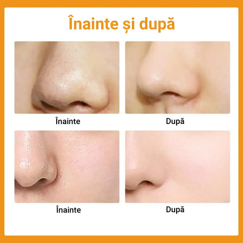 Set 10 Plasturi pentru Puncte Negre HYDROCOLL™