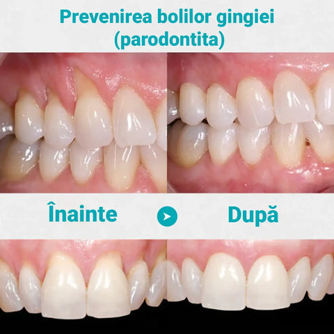 Pachet 7 Fiole pentru Albit Dintii GUM ULTRA White™