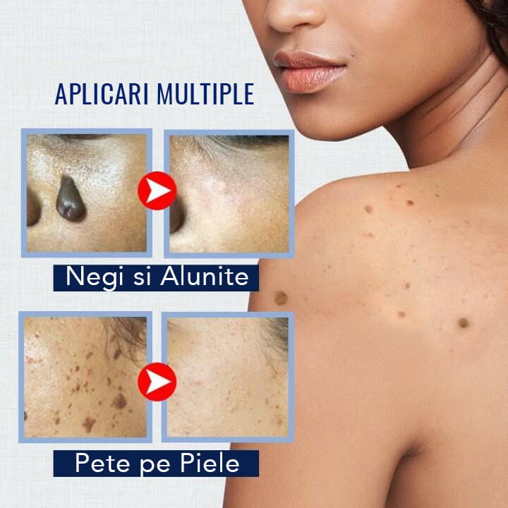 Crema Impotriva Negilor & Petelor Pigmentate WART PRO