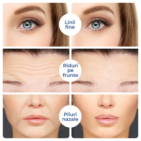 Plasturi pentru Riduri si Cearcane cu Acid Hialuronic MicroAce™