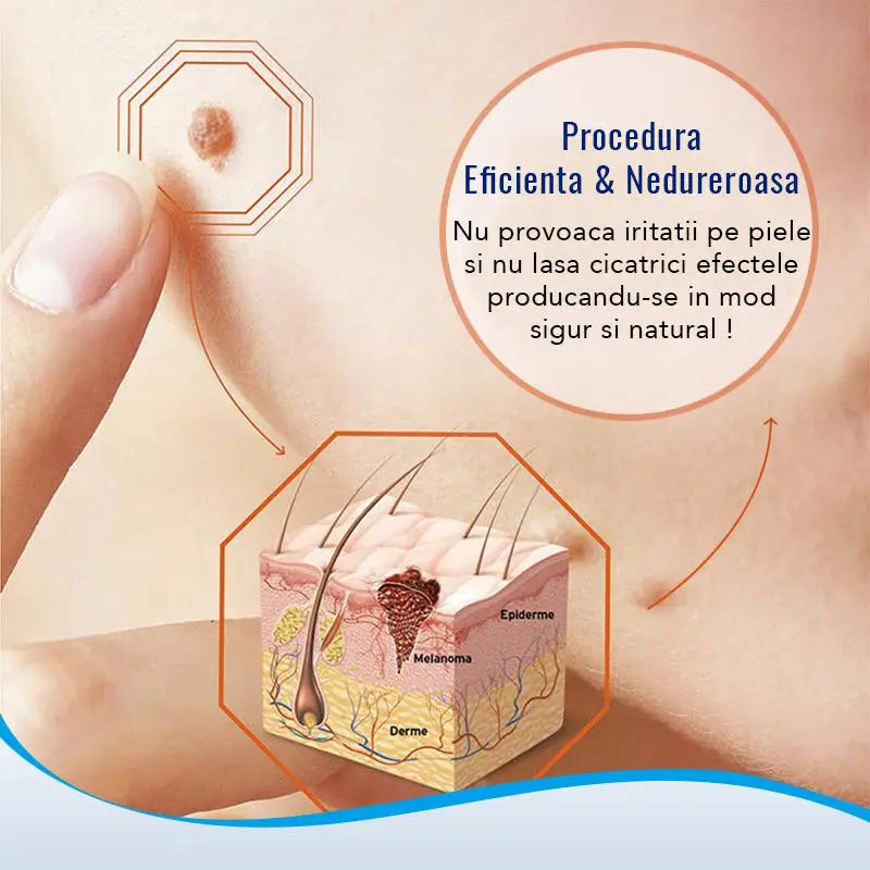 Crema Impotriva Negilor & Petelor Pigmentate WART PRO