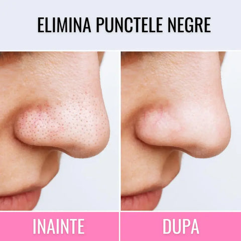 Masca Faciala pentru Puncte Negre Derma LUX™