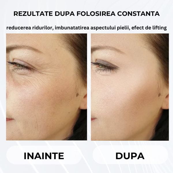 Dispozitiv Lifting Facial cu Micromasaj PROSKIN™